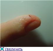 bule de apă din jurul unghiilor pe de o parte, 2 raspunsuri, 38 comentarii, forum consiliere „Dermatologie (bule) Apa bule în jurul valorii de unghii pe de o parte, 2 raspunsuri, 38 comentarii, forum pentru sfaturi „Dermatologie