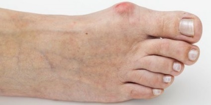 inflamație osoasă a degetului mare - tratamentul bolii (osoase) inflamație osoasă a degetului mare - tratamentul bolii