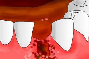 Posibile complicații după articolul extracție dentară (eliminare) Posibile complicații după îndepărtarea dinților Articolul