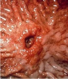 ulcer gastric și duodenal