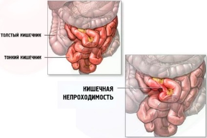 ileus dinamic Cauze, Tratament