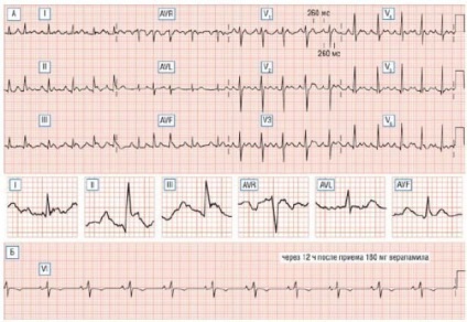 ECG tahicardie atrială