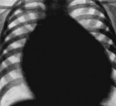 Coarcta a aortei la copii și adulți tratați funcționare și diagnosticare