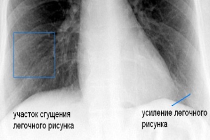 plămânii fumătorului și persoană sănătoasă comparație fotografie