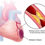 infarct miocardic focală mică