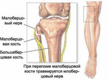 Neuropatia nervului peroneal (degetul mare extensor) Neuropatia nervului peronier