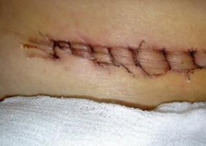 hernie inghinală perioada postoperatorie, reabilitare (perioada) hernie inghinală perioada postoperatorie, de reabilitare