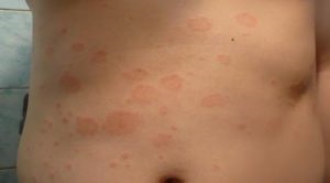 Psoriazis cauze, de la ceea ce pare, cum să prevină agravarea