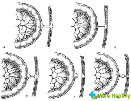 fistula ombilicala