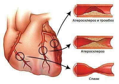 angina cu debut noi cauze, simptome și tratament