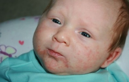 Атопичен дерматит при деца, лечение, диета и примамка