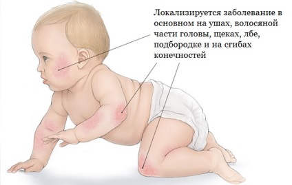 Атопичен дерматит при деца, лечение, диета и примамка
