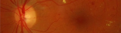 Макулопатия ретината - това, което е опасно, причинява, симптоми и лечения