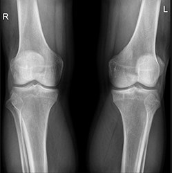 Raze X si alte metode de diagnostic ale patologiei piciorului - să fie sănătos