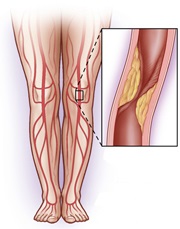 insuficienta arteriala cronica cauze etapa