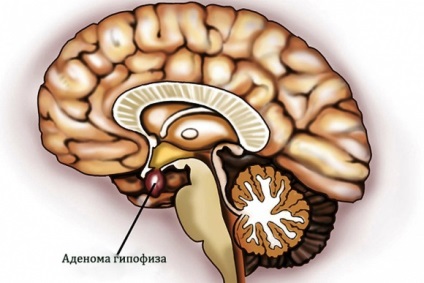 Adenom glanda pituitara a creierului - ceea ce este