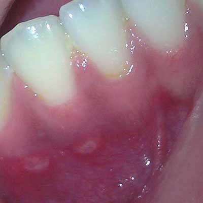 Бели петна (точки) на венците при възрастни и деца