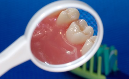 Hurts un plasture alb pe gingii la adulți - ce să facă (ce să facă cu durerea de pete de mestecat) Hurts un plasture alb pe gingii la adulți - ce să facă