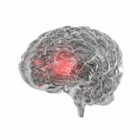 Ce este un accident vascular cerebral (accident vascular cerebral) Ce este un accident vascular cerebral
