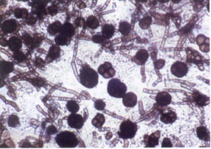 Ce este candidoza sistemică (Candida) Ce este candidoza sistemică