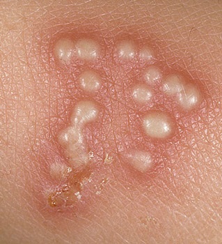 Simptome Herpes gât, tratament, copii, adulți (tratament) simptome Herpes gât, tratament, copii, adulți