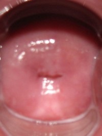 hiperkeratoza cervicală (proces de celule cornificare) hiperkeratoza de col uterin