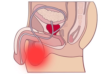 Hernia testiculului la bărbați și copii, simptome, tratament, complicații (copii) Hernia testiculului la bărbați și copii, simptome, tratament, complicații