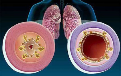 Catarale endobronchitis ce este, gradul de tratament (catarală) Catarale endobronchitis ce este, gradul de tratament
