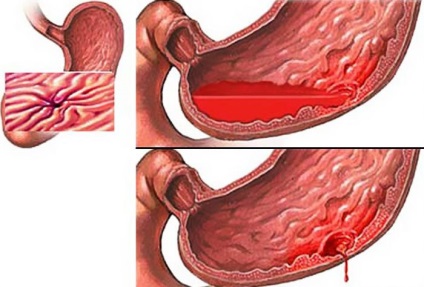 Sangerarea ulcerul gastric si ulcerul duodenal si simptome de tratament