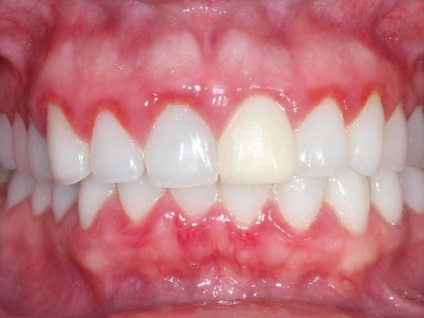 Tratamentul bolilor gingivale - metode pentru tratamentul gingivitelor și periodontita (inflamarea gingiilor pentru a vindeca) Tratamentul bolilor gingivale - metode pentru tratamentul gingivitelor si periodontitei