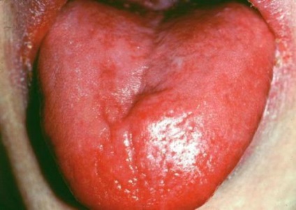 Impetigo pe roșu limbii, plat, cauzele de metode de tratament (cauza) Impetigo pe roșu limbii, plat, cauzele de tratament, metode