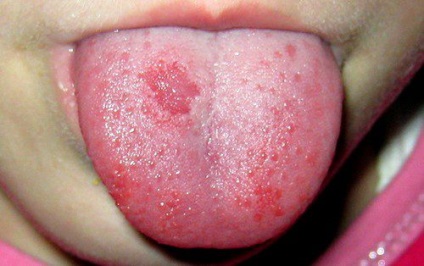 Impetigo pe roșu limbii, plat, cauzele de metode de tratament (limbaj) Impetigo pe roșu limbii, plat, cauzele de tratament, metode