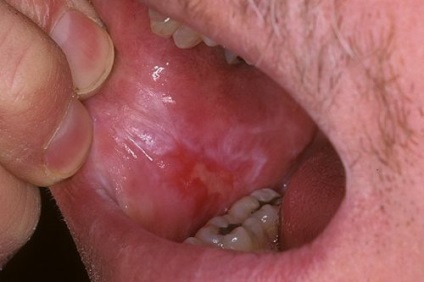 Impetigo pe roșu limbii, plat, cauzele de metode de tratament (limbaj) Impetigo pe roșu limbii, plat, cauzele de tratament, metode