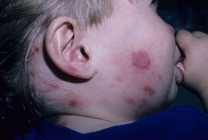 Impetigo pe roșu limbii, plat, cauzele de metode de tratament (plat) Impetigo pe roșu limbii, plat, cauzele de tratament, metode