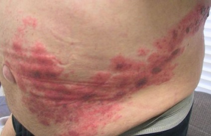 Impetigo pe roșu limbii, plat, cauzele de metode de tratament (plat) Impetigo pe roșu limbii, plat, cauzele de tratament, metode
