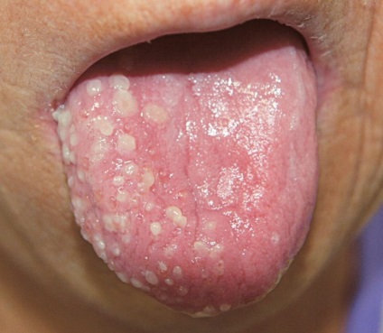 Impetigo pe roșu limbii, plat, cauzele de metode de tratament (cauza) Impetigo pe roșu limbii, plat, cauzele de tratament, metode