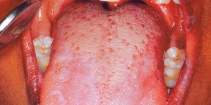 Impetigo pe roșu limbii, plat, cauzele de metode de tratament (roșu) Impetigo pe roșu limbii, plat, cauzele de tratament, metode