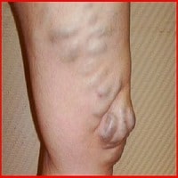 Tratamentul medicamentos al tromboflebita a extremităților inferioare, tratamentul varicelor (inferior) Tratamentul medicamentos al tromboflebita a extremităților inferioare, tratarea venelor varicoase