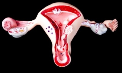 adenomioza uterine Focal (forma adenomioza focal) adenomioza uterin Focal