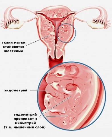 adenomioza uterine Focal (adenomioza uterului) adenomioza uterin Focal
