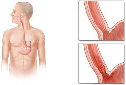 Diagrama Esofagul, o structura (structura esofagului uman) Structura sistemului de Esofag