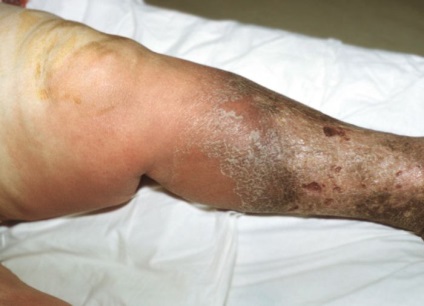 Prevenirea infecțiilor anaerobe (prevenirea infecțiilor anaerobe) Prevenirea infecțiilor anaerobe