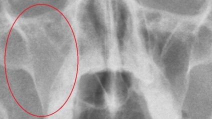 Razele X ale sinusurilor nazale în cazul în care și cât de des puteți face, decodare (nas) Razele X ale sinusurilor nazale în cazul în care și cât de des puteți face, descifrarea