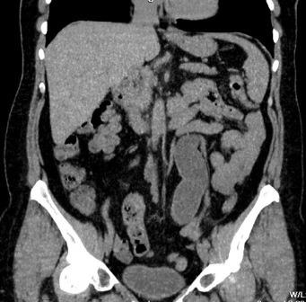 cavitatea abdominală HCT (retroperitoneal abdominal) SKT organe abdominale