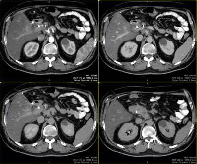 HCT abdominal (peritoneal) SKT organe abdominale