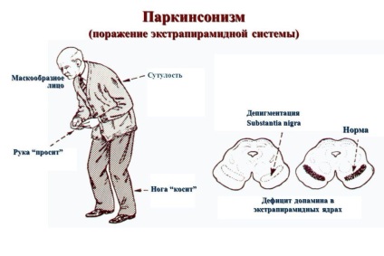 Tremor și alcool (alcool) Tremor și alcool