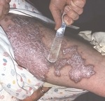 Extrapulmonară tuberculoza, forme, tipuri de tuberculoza extrapulmonară, simptome, diagnostic, tratament (extrapulmonary) tuberculoza extrapulmonară, forme, tipuri de tuberculoza extrapulmonara, simptome, diagnostic, tratament