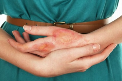 Blistere pe palmele în cazul în care provin de la, de ce sunt mâncărime pentru a scapa (palmele) Blistere pe palmele în cazul în care provin de la, de ce sunt mâncărime pentru a scăpa
