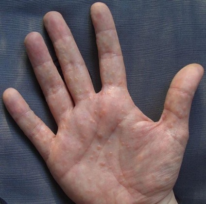 Blistere pe palmele în cazul în care provin de la, de ce sunt mâncărime pentru a scăpa (bășici) Blistere pe palmele în cazul în care provin de la, de ce sunt mâncărime pentru a scăpa