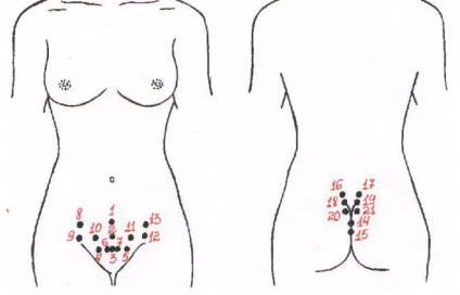 ademioza uterin - ceea ce este simptome și tratament în timpul sarcinii (uter) ademioza uterin - ceea ce este simptome și tratament în timpul sarcinii